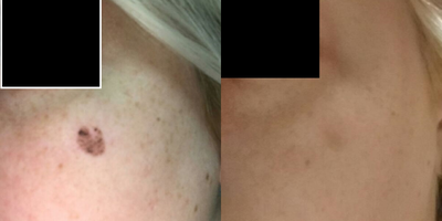 IPL before and after photo