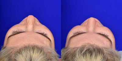 Rhinoplasty before and after photo