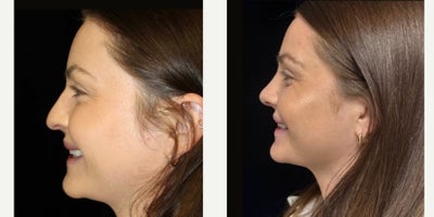 Rhinoplasty before and after photo