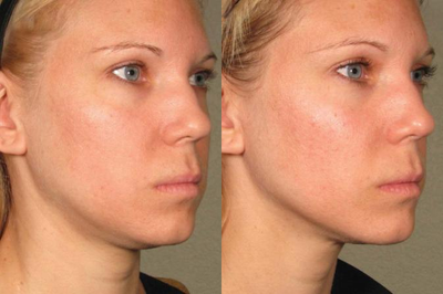 Ultherapy before and after photo