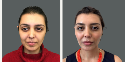 Buccal Fat Removal before and after photo