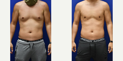 Gynecomastia Surgery before and after photo
