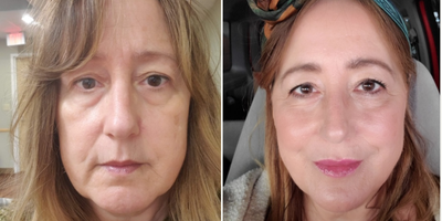 Juvederm before and after photo