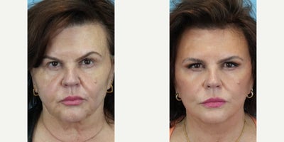 Rhinoplasty before and after photo
