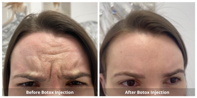 Botox before and after photo
