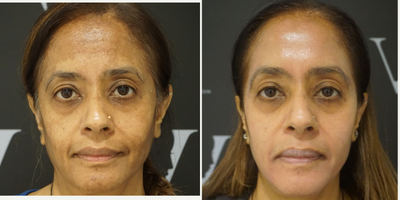 Dermal Fillers before and after photo