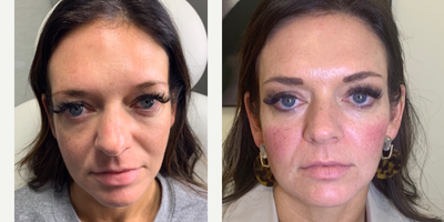 Dermal Fillers before and after photo