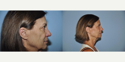Eyelid Surgery before and after photo