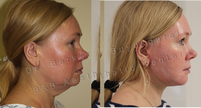 Facelift before and after photo
