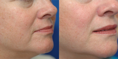 Radiesse before and after photo