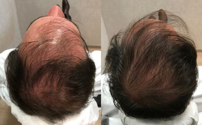 Hair Loss Treatment before and after photo