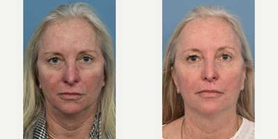 IPL before and after photo