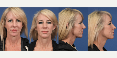 Botox before and after photo