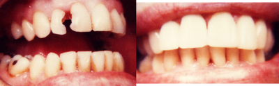 Dental Bonding before and after photo