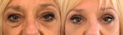 Eyelid Surgery before and after photo