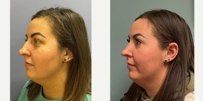 Septoplasty before and after photo