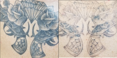 Tattoo Removal before and after photo