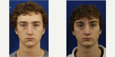 Chin Implant before and after photo