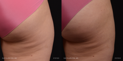 CoolSculpting before and after photo