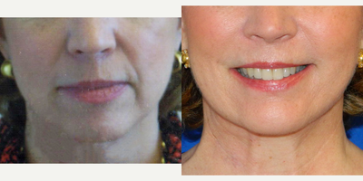 Facelift before and after photo