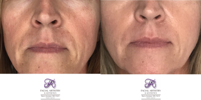 IPL before and after photo
