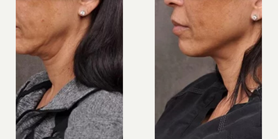Profound RF before and after photo