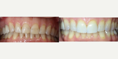 Smile Makeover before and after photo