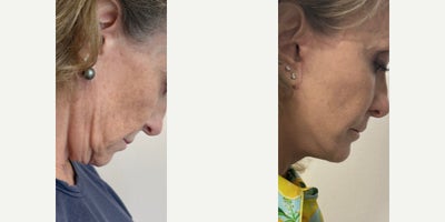Deep Plane Facelift before and after photo