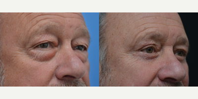 Eyelid Surgery before and after photo