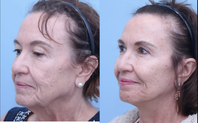 Facelift before and after photo