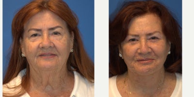 Neck Lift before and after photo