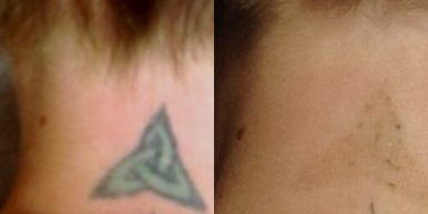 Tattoo Removal before and after photo
