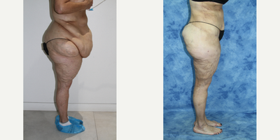 Tummy Tuck before and after photo