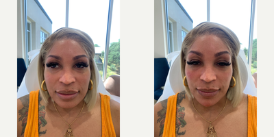 Chin Filler before and after photo