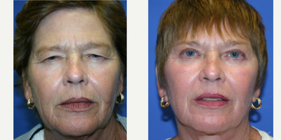 CO2 Laser before and after photo