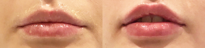 Dermal Fillers before and after photo