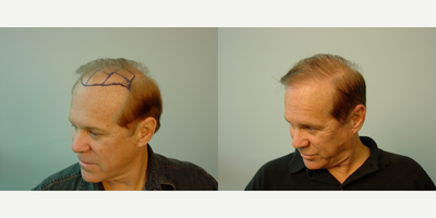 Hair Transplant before and after photo