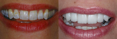 Porcelain Veneers before and after photo