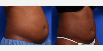 CoolSculpting before and after photo