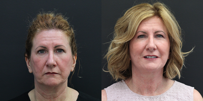 Facelift before and after photo