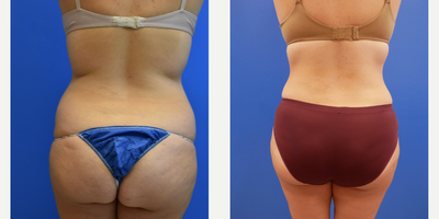 Tummy Tuck before and after photo
