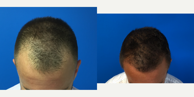 FUE Hair Transplant before and after photo