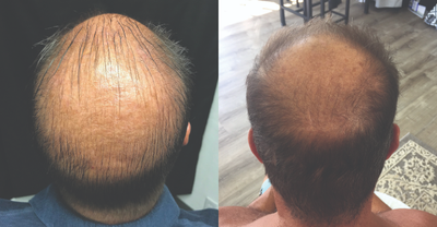PRP for Hair Loss before and after photo