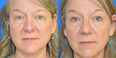 Revision Rhinoplasty before and after photo