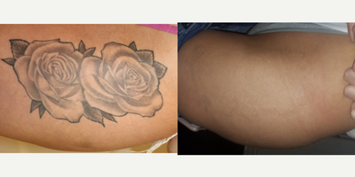 Tattoo Removal before and after photo