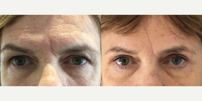 Brow Lift before and after photo
