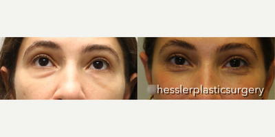 Facial Fat Transfer before and after photo