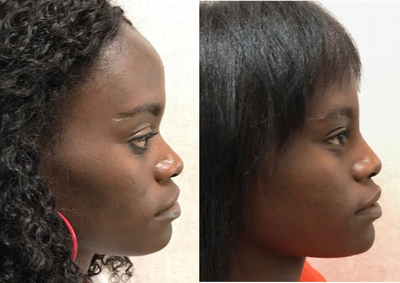 Nonsurgical Nose Job before and after photo