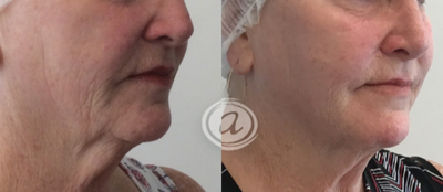 Radiesse before and after photo