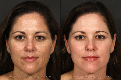Restylane before and after photo
